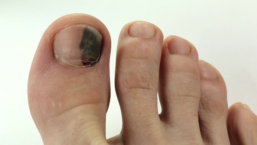 black-toenail-causes-treatment-and-prevention-tips-feet-first-clinic