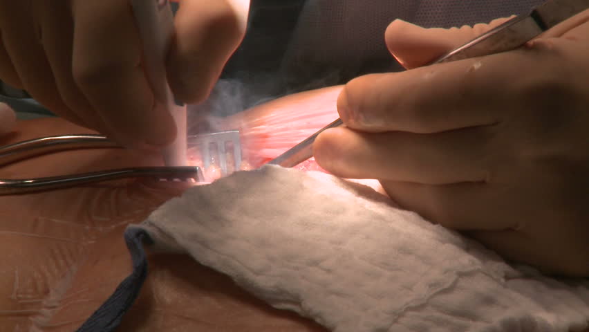 Cartilage removal during open heart surgery