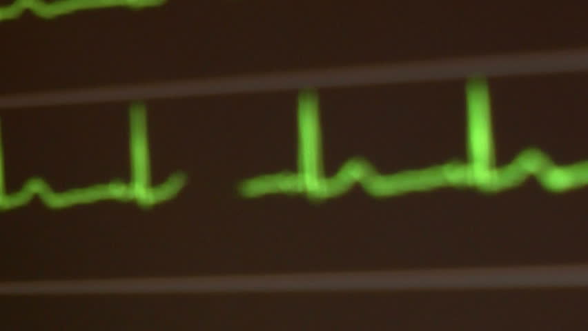 ECG or EKG monitor, soft focus to sharp focus, close up, zoom out, displays multiple readings . 1080p