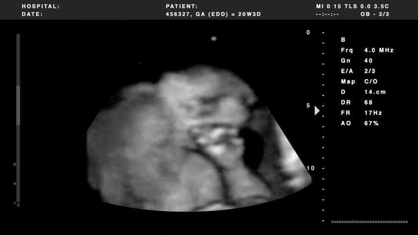 Video out put from a 4D ultrasound combined with graphics.