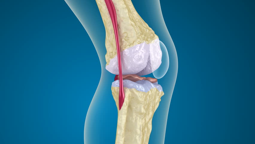 Osteoporosis of the knee joint.