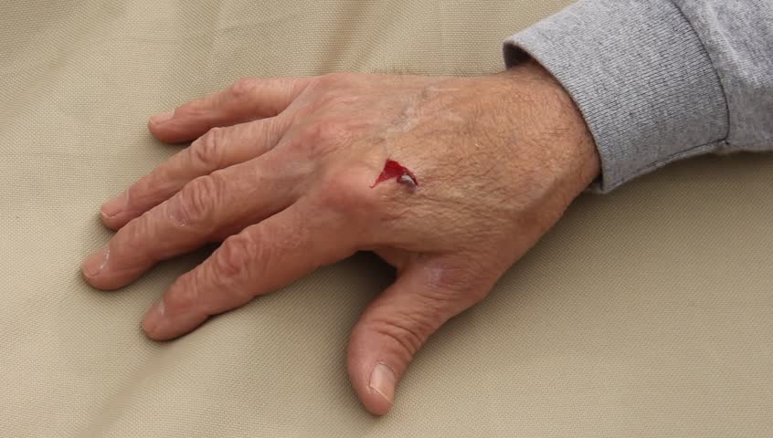 applying a bandage to an injured hand