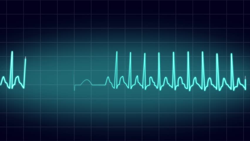 Animated EKG Display Stock Footage Video 7733152 Animated EKG Display Stock Footage Video 7733152