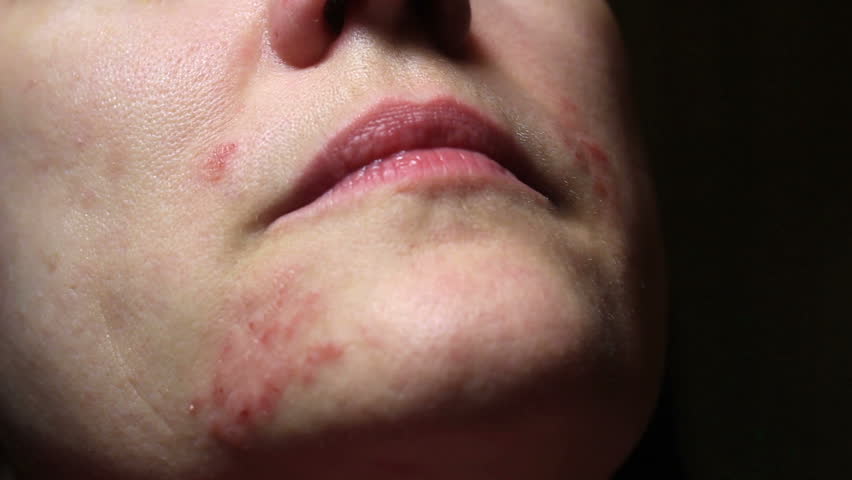 Header of allergic