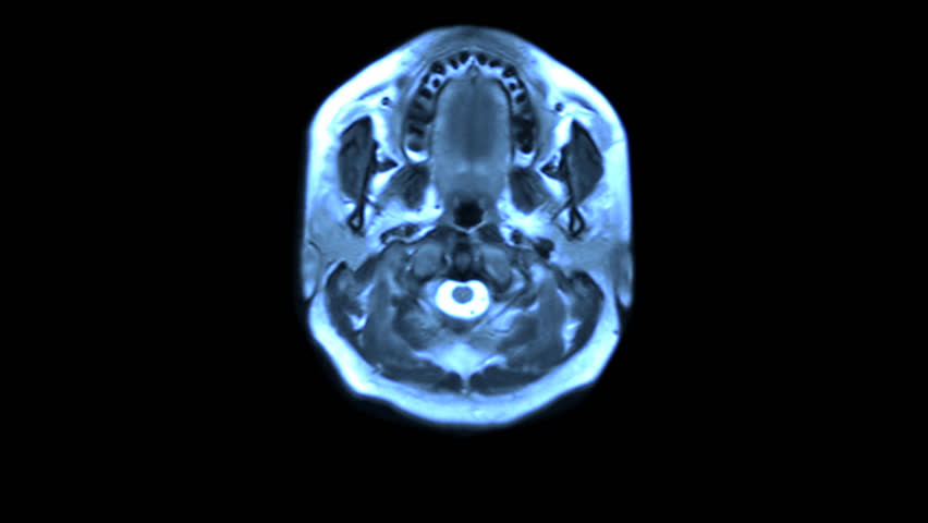 MRI brain scan