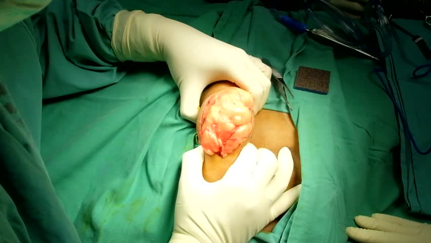 Header of lipoma