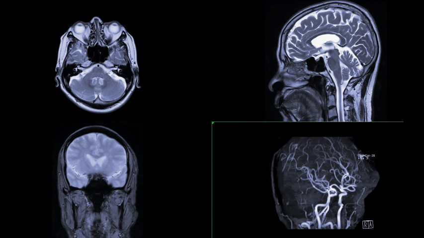 Кт ангиография аневризма. Мра сосудов головного мозга. Магнитно-резонансная ангиография шеи. Магнитно-резонансная ангиография шеи. Кт ангиография сосудов головного мозга.