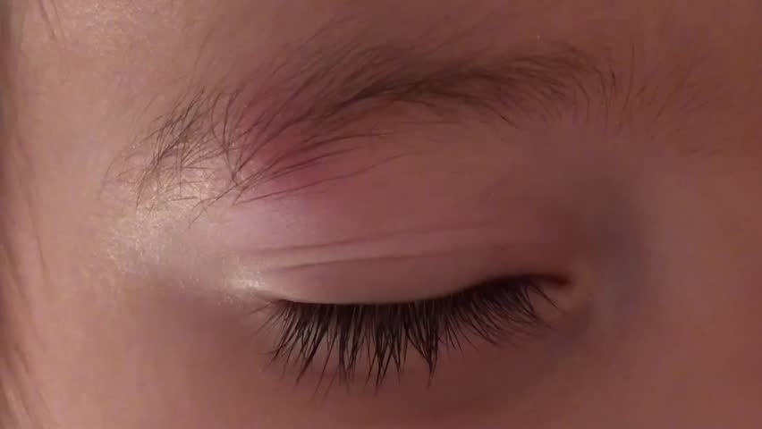 Painful Lump Under Eyebrow