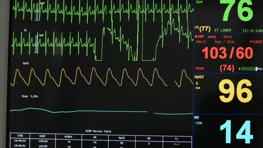 Hospital Patient Monitor In Operating Theater Displaying EKG, Pulse ...