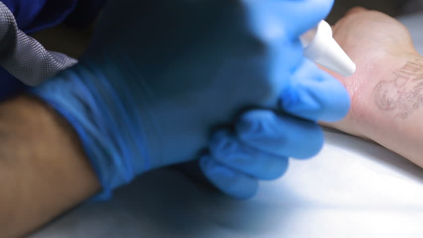 laser tattoo removal with hand stock footage video 22185061 laser tattoo removal with hand stock footage video 22185061