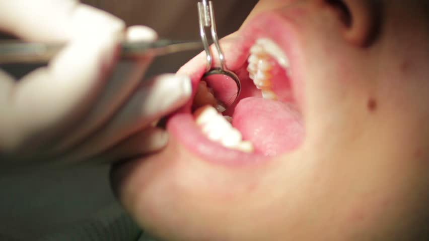 Closeup Of Patient Open Mouth During Oral Checkup Stock Footage Video