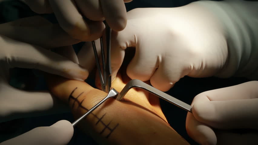 Header of bunion