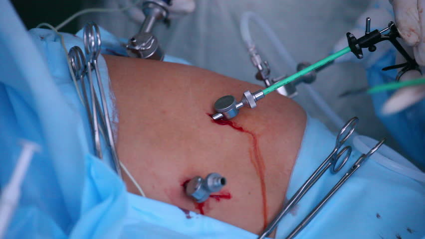 Laparoscopic Surgery of the Abdomen